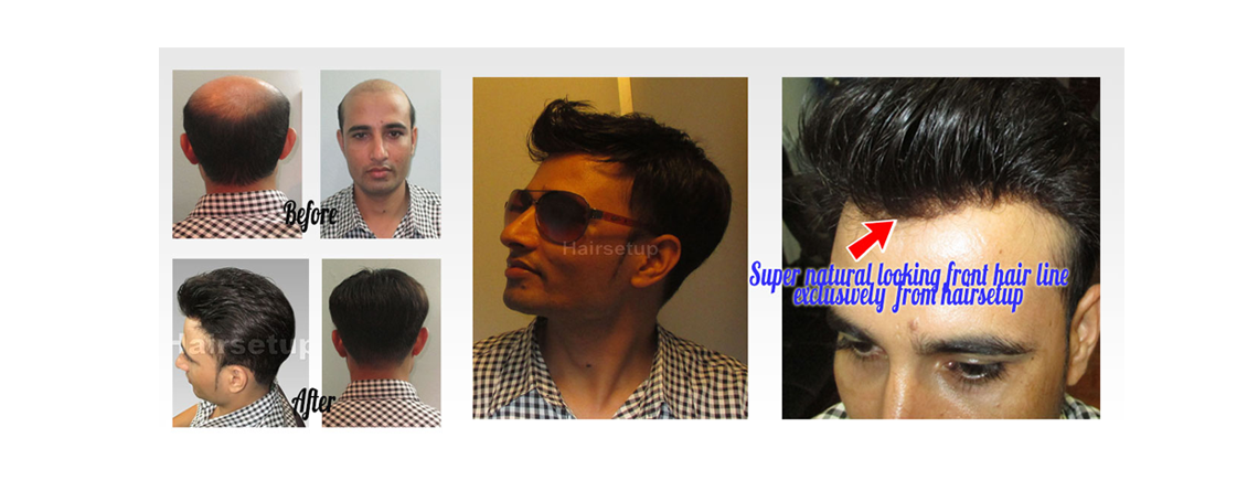 Custom Hair Replacement Systems And Toupees For Men And Women With